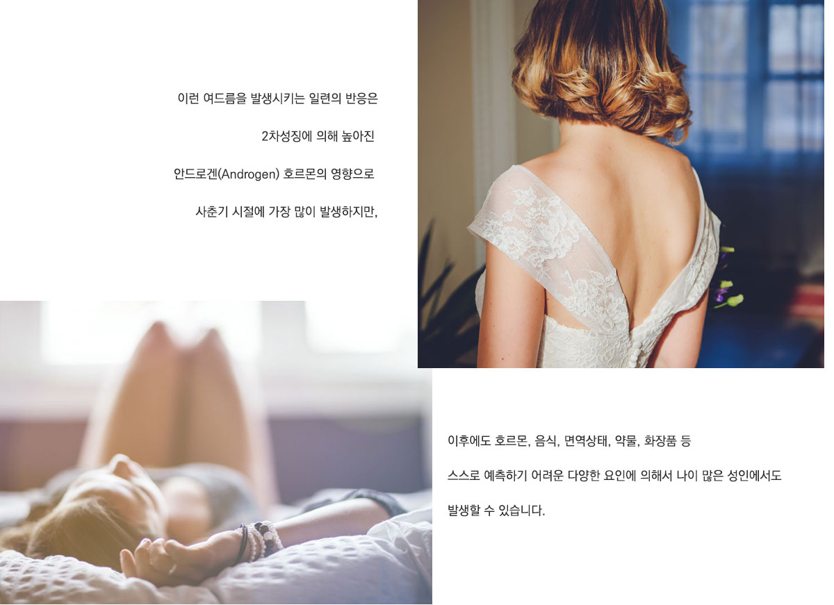 이런 여드름을 발생시키는 일련의 반응은 2차성징에 의해 높아진 안드로겐 호르몬의 영향으로 사춘기 시절에 가장 많이 발생하지만 이후에도 호르몬, 음식, 면역상태, 약물, 화장품 등 스스로 예축하기 어려운 다양한 요인에 의해서 나이 많은 성인에서도 발생할 수 있습니다.