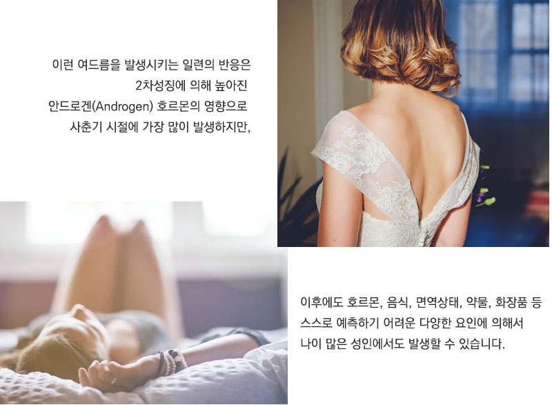이런 여드름을 발생시키는 일련의 반응은 2차성징에 의해 높아진 안드로겐 호르몬의 영향으로 사춘기 시절에 가장 많이 발생하지만 이후에도 호르몬, 음식, 면역상태, 약물, 화장품 등 스스로 예축하기 어려운 다양한 요인에 의해서 나이 많은 성인에서도 발생할 수 있습니다.